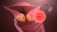 Habrá jornada de colposcopías sin costo por el Día Mundial contra el Cáncer Cérvico Uterino
