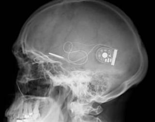 El dispositivo electrónico manda señales al cerebro con lo que los pacientes podrán distinguir formas y percibir la luz.