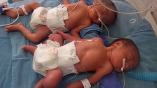 Prematuros. Los trillizos nacieron el 11 de diciembre en el ISSSTE de Torreón a los siete meses de gestación. Dos de ellos compartieron una misa bolsa. 