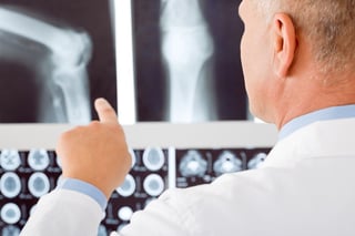 Cada 20 segundos hay una fractura por osteoporosis en el mundo y la menopausia eleva el riesgo de sufrir este padecimiento que afecta a los huesos. (ARCHIVO)