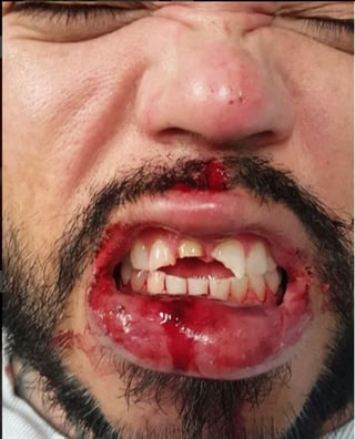 El músico mexicano-estadounidense publicó en su cuenta de Instagram una imagen con su dentadura rota. (ESPECIAL)