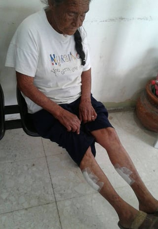 Lesiones. La mujer de 85 años de edad fue mordida en ambas las piernas por seis perros.