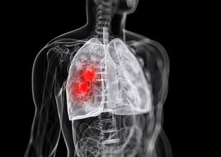 En la actualidad se sabe que el cáncer de pulmón es una de las enfermedades más graves y mortales dentro de la población, ya que una de cada 17 personas puede desarrollar dicho carcinoma pulmonar. (ARCHIVO)