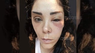 Marichelo Puente, hermana de la cantante se sometió a un tratamiento que consistía en inyectar su propia sangre en el rostro. (ESPECIAL)