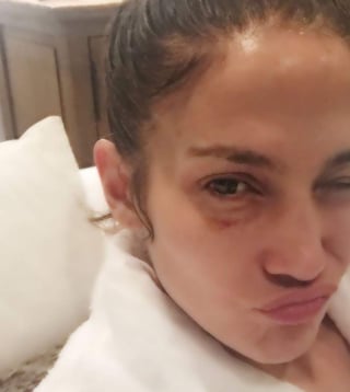 La 'Diva del Bronx' subió una imagen a su cuenta de Instagram, donde aparece haciendo un puchero y mostrando su ojo derecho con un moretón. (INSTAGRAM)