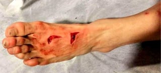 Héctor Herrera necesitó 17 puntos de sutura por un golpe en el pie provocada por  Stephan Lichtsteiner. (Cortesía Héctor Herrera)