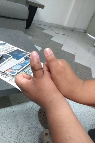 Pierde movilidad. El dedo pulgar izquierdo de Juan Manuel Palacios perdió toda su funcionalidad en un accidente laboral, ha tenido problemas para encontrar empleo a causa de ello. (ROBERTO ITURRIAGA)