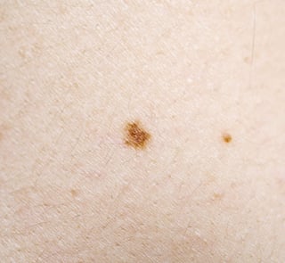 Según la dermatóloga  Ana Rosa Alvarado Rivas el melanoma es el cáncer de piel mas agresivo que hay. (ARCHIVO) 