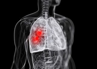 En México el 99 % de los casos de cáncer de pulmón se diagnostican en fase tres o cuatro, en tanto que en el resto de los países de la región la tasa es del 85 %. (ARCHIVO)