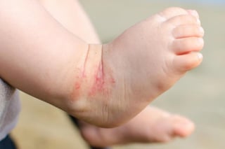 Médicos del IMSS señalan que los problemas cutáneos más frecuentes en los bebés, es la dermatitis ocasionada por el uso del pañal.