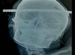La vara de hierro entró por un lado de su cráneo y salió por el otro. (INTERNET)