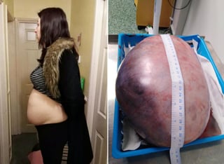 La mujer dice que tras la cirugía, pesó 10 kilogramos menos. (INTERNET)