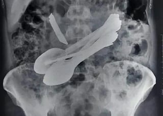 Las radiografías mostraron los utensilios, para al comenzar la operación se dieron cuenta que había más. (INTERNET)