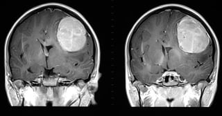 Es un tumor cerebral que está entre los más letales y difíciles de tratar dado que los pacientes suelen desarrollar resistencias al tratamiento. (ESPECIAL)