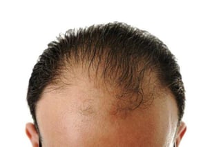 Un descubrimiento que puede revolucionar la industria relacionada con el problema de la alopecia o pérdida del cabello. (ARCHIVO)