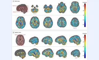 Ragini Verma, experta en tomografías del cerebro para la Universidad de Pensilvania y la principal autora del estudio, dijo que las afecciones que vio son distintas a cualquier otra que haya visto en cerebros atrofiados o lesionados. (AP)