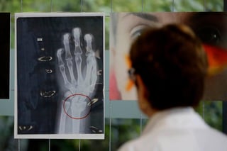 El anonimato de las pacientes fue respetado al exhibir las cinco radiografías, incluyendo una que muestra la larga hoja de un cuchillo alojada en el abdomen de una mujer. Otras muestran fracturas en extremidades, entre ellas una barbilla partida en dos. (ESPECIAL)