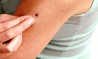 La dermatofibrosarcoma protuberans es un cáncer de piel poco frecuente, que aparece en la piel como un pequeño bulto, explica la Academia Americana de Dermatología (AAD). (ESPECIAL) 