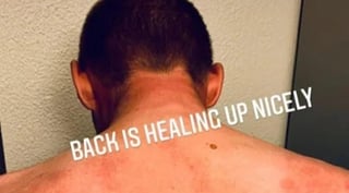 Por medio de Instagram el ciclista compartió una fotografía con hematomas en su espalda, resultado del impacto del granizo en ésta (CAPTURA) 