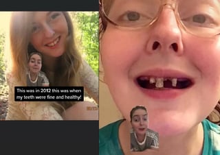 Sus dientes se pudrieron y tuvo que someterse a varios procedimientos para una dentadura postiza. (INTERNET)