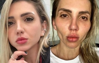 La 'influencer' compartió un antes y después de la bichectomía en Instagram (CAPTURA) 