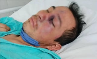 Gregorio Avendaño Jiménez, el paciente sospechoso de haber contraído una infección de 'hongo negro', sigue luchando por su vida, en el hospital Centro Médico de 'La Raza'; la madrugada de este viernes, fue intervenido por especialistas y cirujanos del nosocomio capitalino. (ESPECIAL)