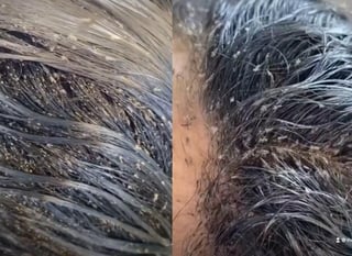 A través de TikTok, el centro de salud que atendió el caso de la niña compartió un video donde se aprecia la cabeza de ésta llena de miles de piojos (CAPTURA) 