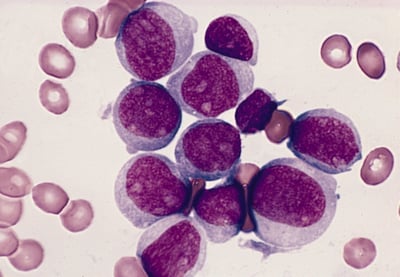 La Leucemia Mieloide Aguda es uno de los tipos de cáncer más complejos. (EL SIGLO DE TORREÓN)