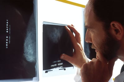 Imagen Síntomas que podrían indicar que un hombre padece cáncer de próstata