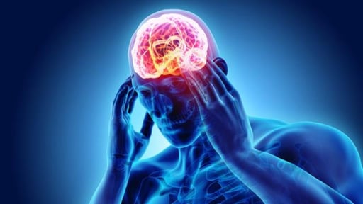 Imagen 10 tips para terminar con la cefalea, según neurólogos
