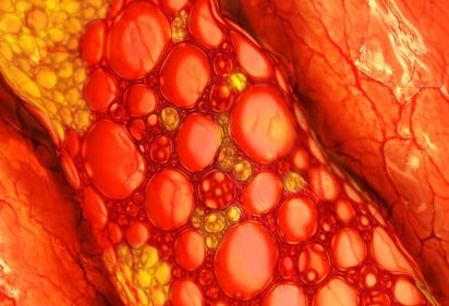 Placa de colesterol en vasos sanguíneos.