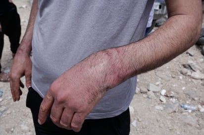  Un vecino del campamento de refugiados palestino de Nur Shams muestra las heridas causadas por las esposas que le pusieron las fuerzas de seguridad israelíes durante su detención, los tres días que duró su asalto al campamento, ayer domingo en Tulkarem. (EFE)