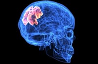 ¿Qué es la trombosis y qué la genera?