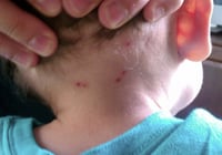 La Laguna, con un caso confirmado y otro sospechoso de Rickettsia