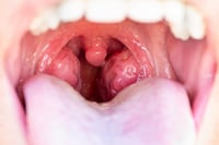 What happens if you have your tonsils removed?