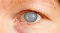Imagen ¿Cómo detectar el glaucoma a tiempo?