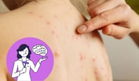 Imagen Varicela es altamente contagiosa y primera causa de encefalitis viral: Pediatra