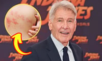 Imagen ¿Qué es herpes zóster, infección que aqueja a Harrison Ford?