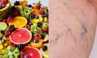 + Salud Come esta fruta para combatir las varices