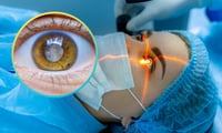 + Salud ¿Tienes cataratas? Así puedes solicitar una cirugía gratis