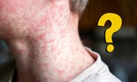 + Salud Sarampión, viruela, varicela y escarlatina: ¿cómo se diferencian?