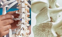 + Salud Mitos: osteoporosis y tercera edad