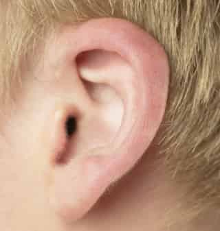 La cirugía conocida como otoplastia, reduce el tamaño de las orejas y consiste en coserlas, literalmente, a la cabeza, por medio dos o tres puntos de sutura.