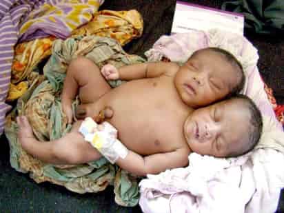 Niño con dos cabezas