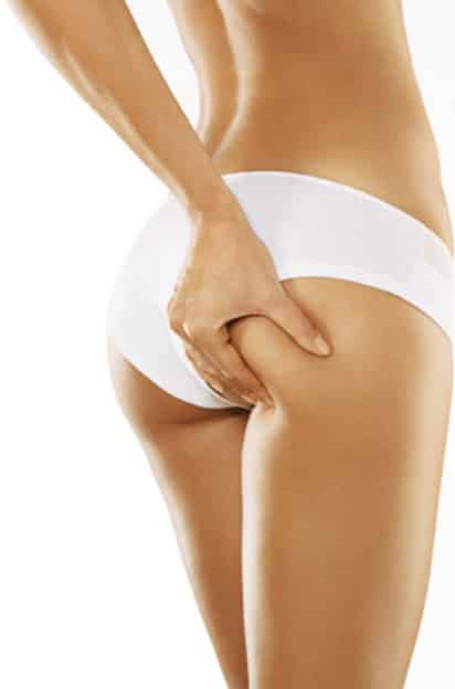 Estudios epidemiológicos afirman que 98 por ciento de las mujeres de las poblaciones occidentales tienen celulitis, sin importar su talla. 