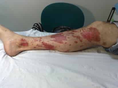 La quemadura de segundo grado o tipo Aba ocurre cuando se presenta destrucción de la epidermis y de gran parte de la epidermis superficial y medial, se conservan los anexos cutáneos y los flictemas o ampollas son de coloración oscura y generalmente están rotos. INTERNET