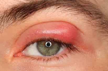 La conjuntivitis es una afección que puede ser bacteriana o irritativa, la cual se caracteriza por enrojecimiento del ojo aunado a una sensación de cuerpo extraño al interior del mismo. ARCHIVO