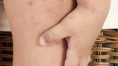 Los síntomas de la enfermedad son fiebre alta, malestar general, dolor de garganta, úlceras en la boca y salpullido en las extremidades. (ARCHIVO)