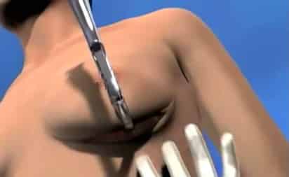 Una mujer de 42 años falleció al interior de una clínica de belleza ubicada en la colonia Huexotitla de la ciudad Puebla, cuando se realizaba una operación de liposucción y aumento de senos. (TWITTER)