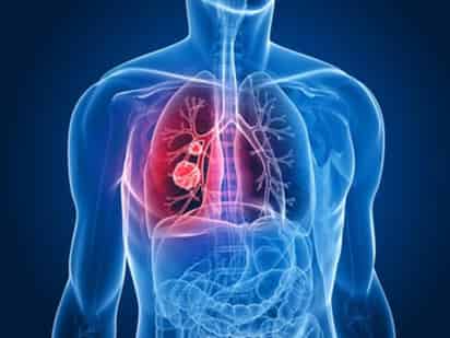 El cáncer de pulmón representa un 25% de todas las muertes por cáncer en el mundo, y es la principal causa de muerte por cáncer entre hombres y mujeres. (ESPECIAL) 